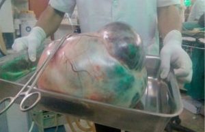 पाँच किलो ट्युमरको सफल शल्यक्रिया
