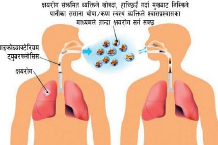 औषधि अभावका कारण क्षयरोगीको ज्यान जोखिममा